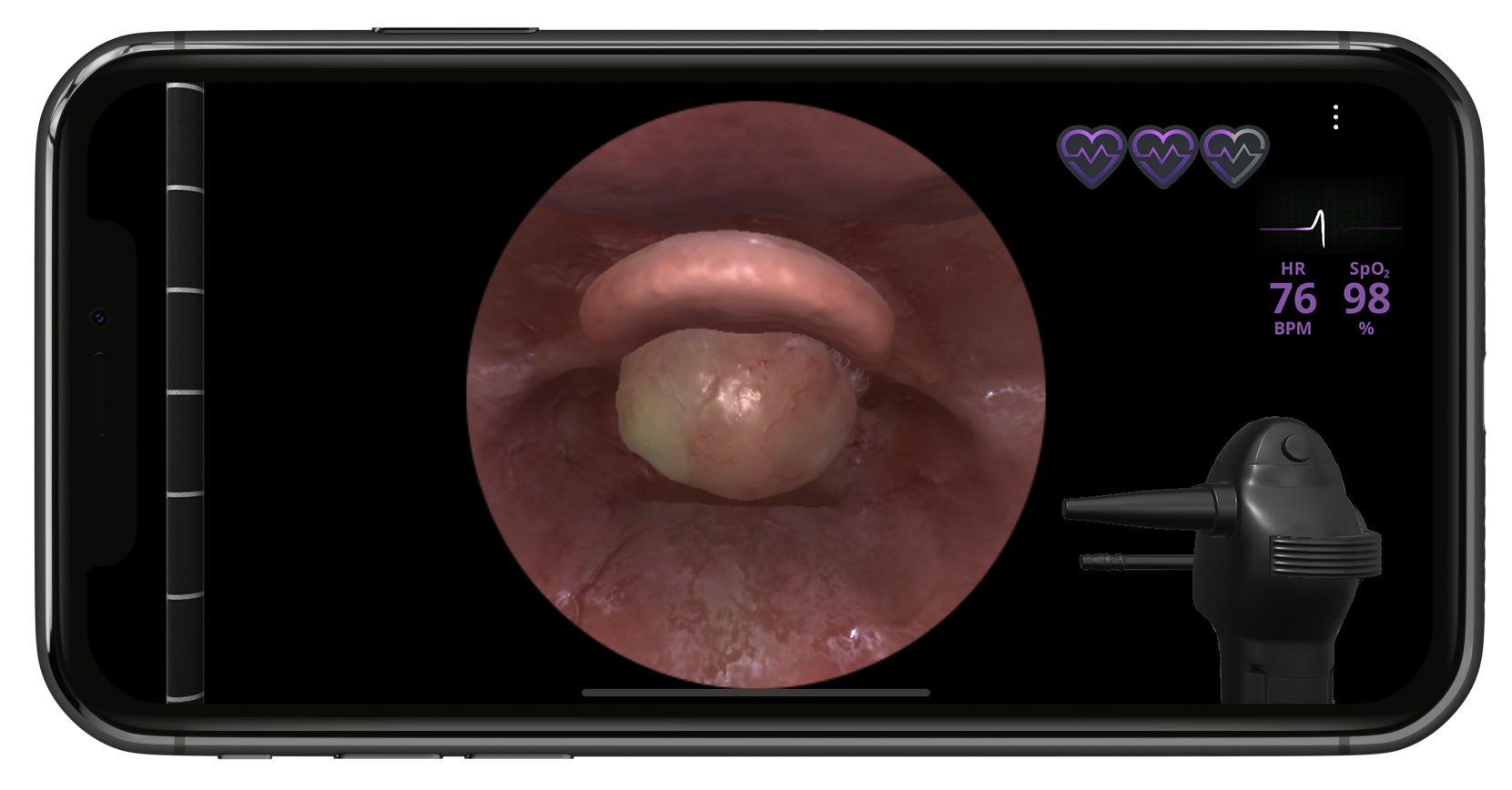 large obstructing tumor blog 12 cme