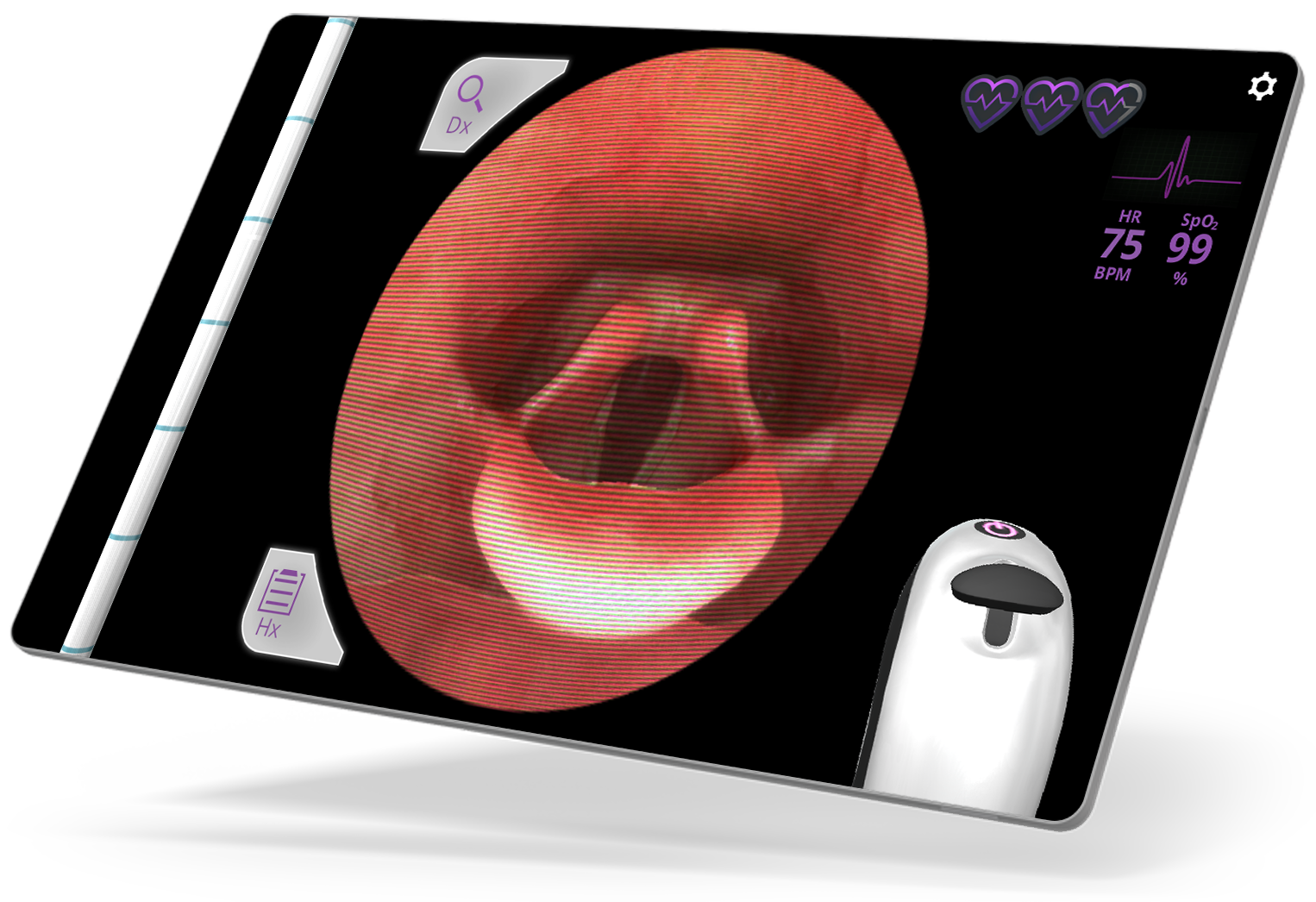 Airway Ex Hoarseness Case