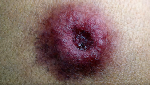 Top Derm Render - BC Carcinoma