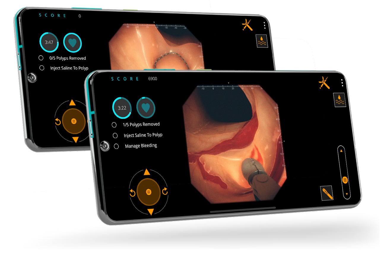 Gastro Ex - Forcep Pull Polyp and Fluids Cold Snare