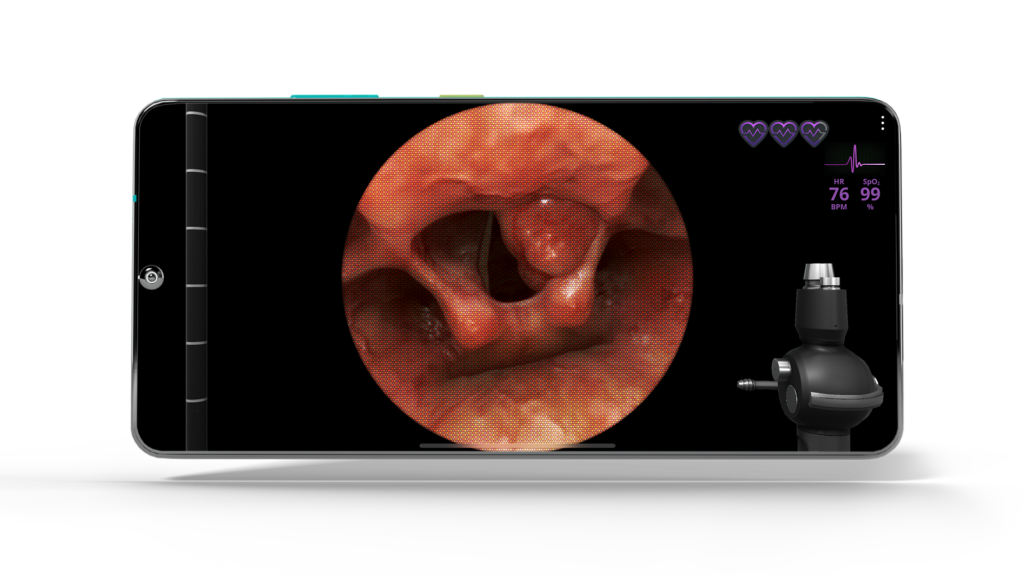 Airway Ex Rare Supraglottic Tumor Case