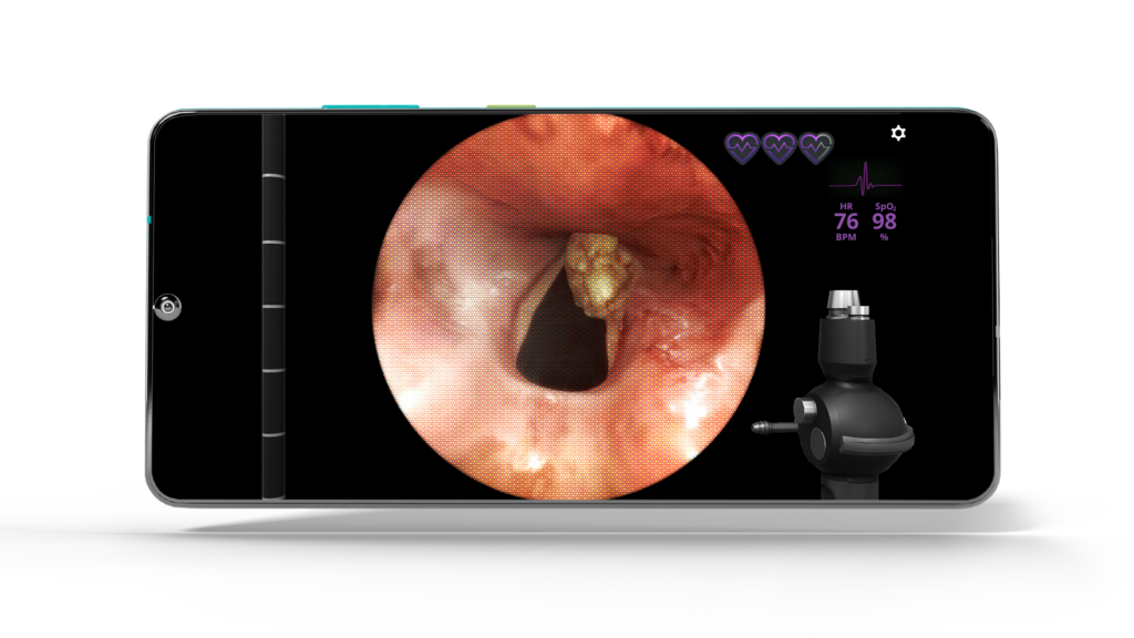 Airway Ex Adult Intubation: Glottic Tumor Case