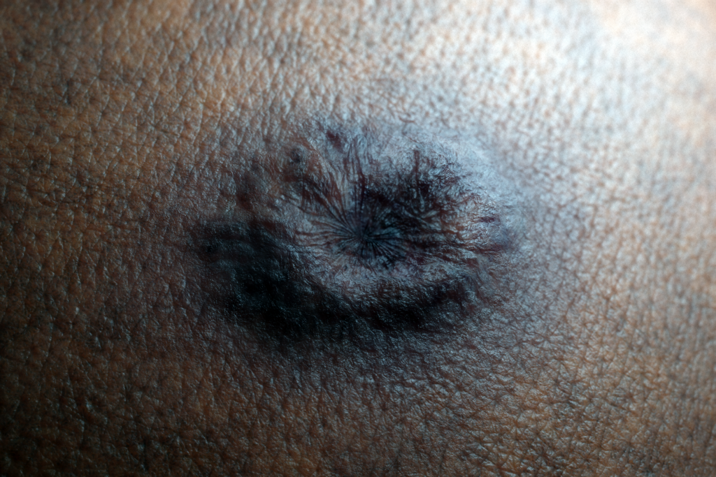 Top Derm Basal Cell Carcinoma