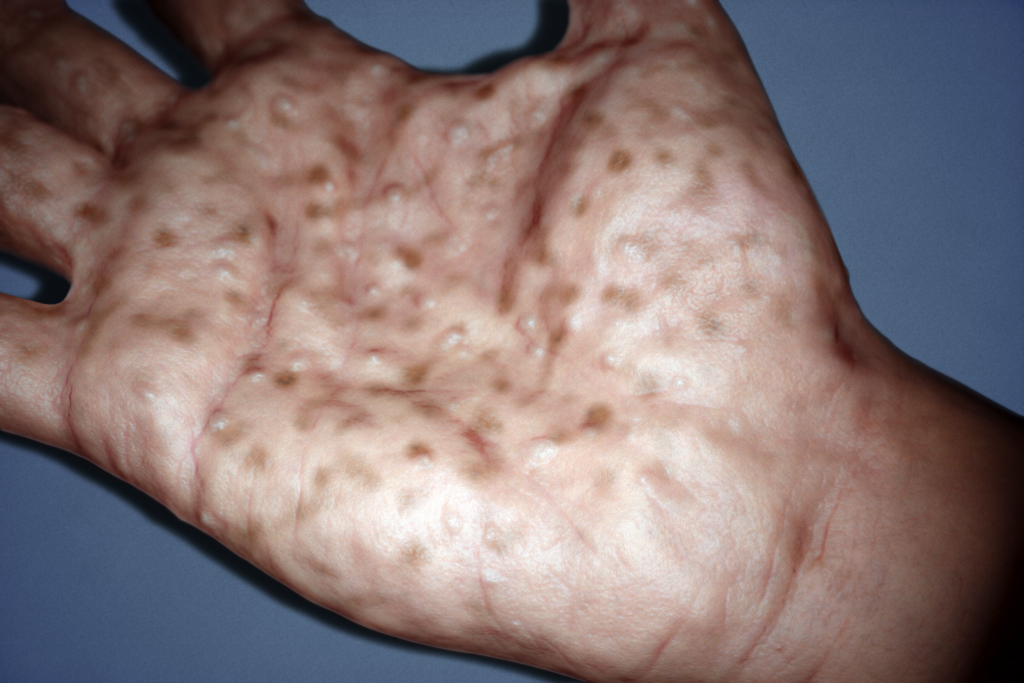 Top Derm Dyshidrotic Eczema