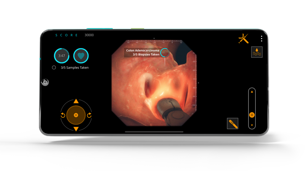 Gastro Ex screenshot featuring Device Forcep Pulling Polyp for Colon Adenocarcinoma for biopsy