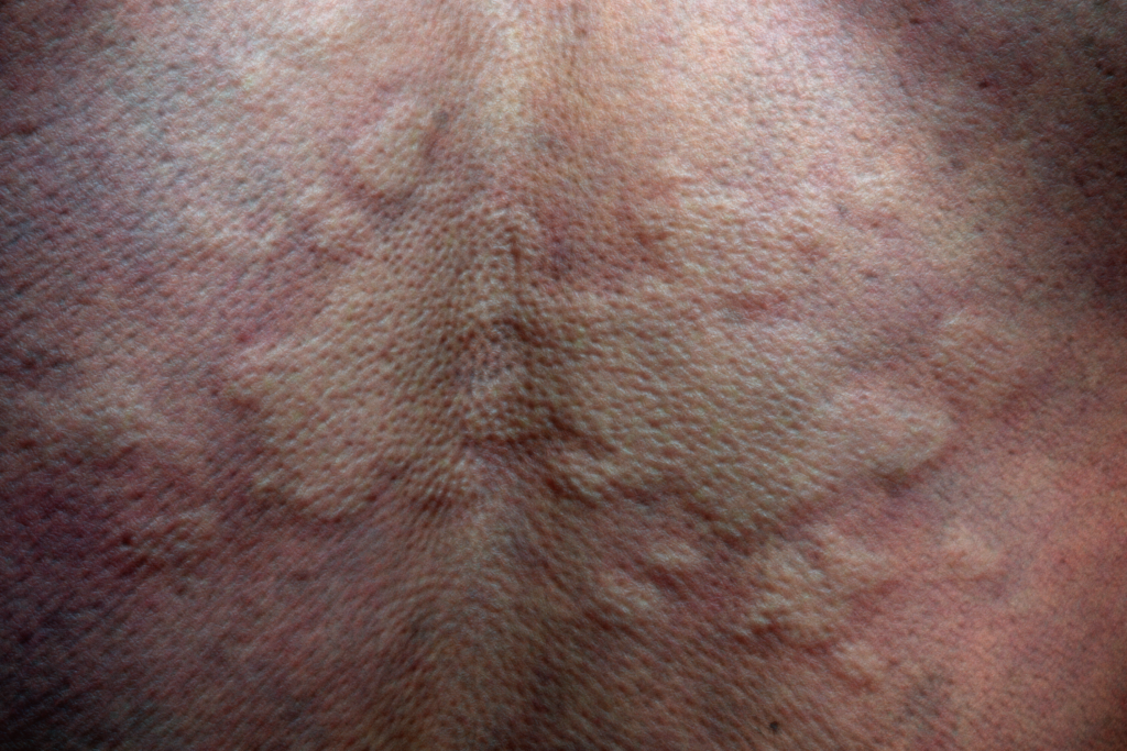 Top Derm Hives (urticaria)