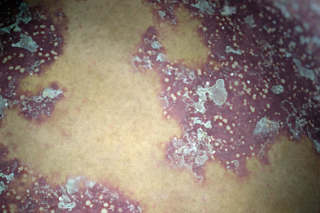 Top Derm General Psoriasis