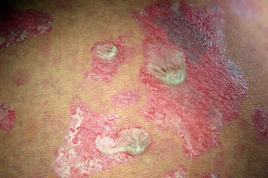 Top Derm Severe Psoriasis