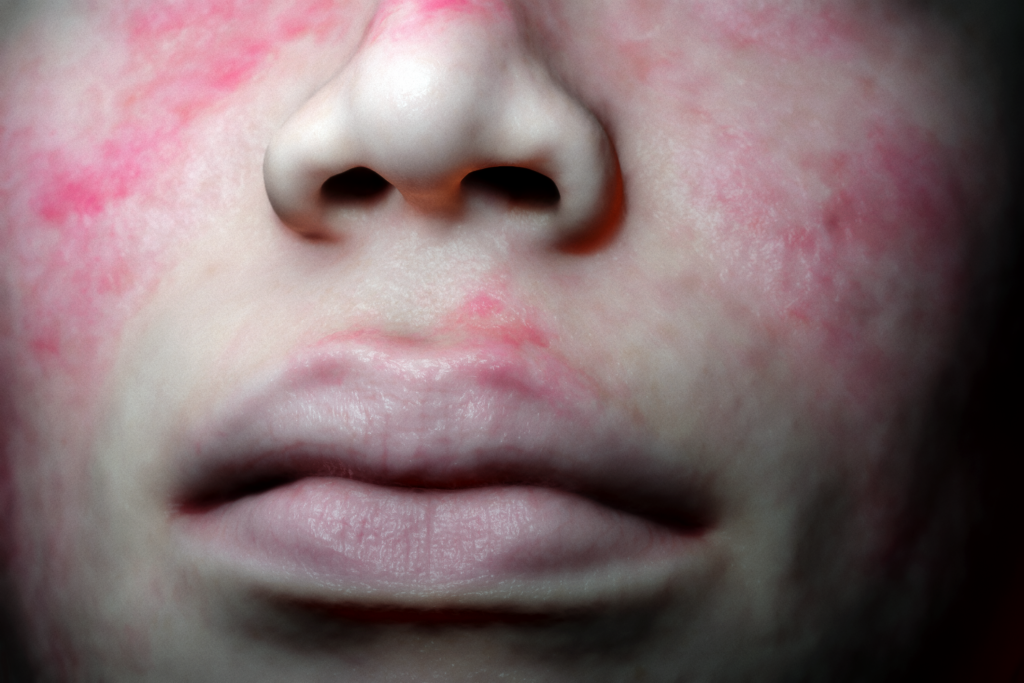 Top Derm Systemic Lupus Erythematosus (SLE)